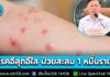 กรมควบคุมโรค เผย “โรคอีสุกอีใส” พบผู้ป่วยเพิ่มช่วงต้นปี ป่วยสะสมกว่า 1 หมื่นราย โดยเฉพาะในกลุ่มเด็กเล็กและเด็กวัยเรียน