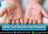 กรมควบคุมโรค เตือน “โรคมือเท้าปาก” เริ่มระบาดช่วงเปิดเทอมรับหน้าฝน แนะผู้ปกครอง และสถานศึกษาเพิ่มการเฝ้าระวังในเด็กเล็ก
