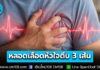 หมอเตือน! “ภาวะหลอดเลือดหัวใจตีบ 3 เส้น” ภัยเงียบที่นำไปสู่การเสียชีวิตเฉียบพลัน เผยสัญญาณเตือน