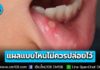 แผลในปาก อาจไม่ได้เป็น “ขาง” เสมอไป! แพทย์ มช. เผยจุดสังเกต แผลแบบไหนไม่ควรปล่อยไว้ เสี่ยงมะเร็งในช่องปาก